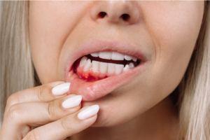 Woman with inflamed gums and mouth sores showing chemotherapy side effects on oral tissues.