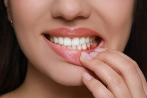 Gum Disease treatment in Houston