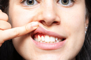 Bleeding Gums