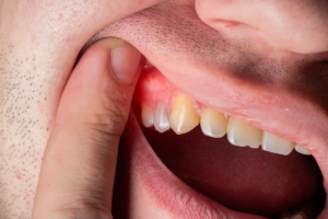 Early Gum Disease