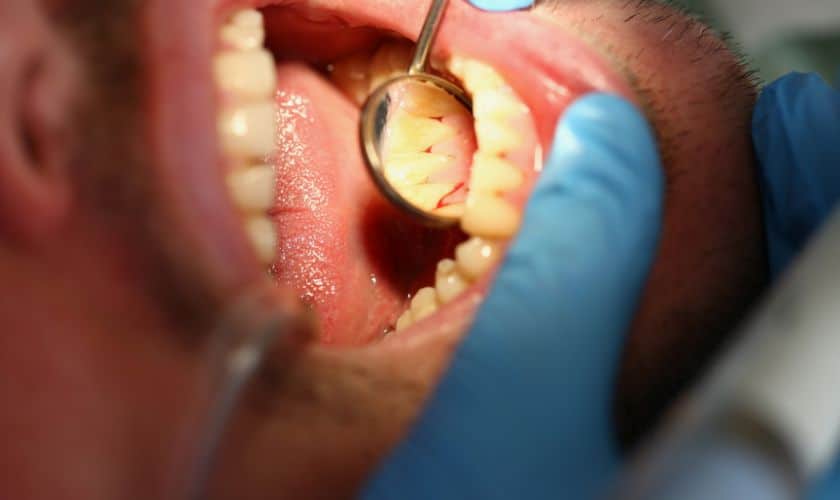 Gum cleaning in Houston