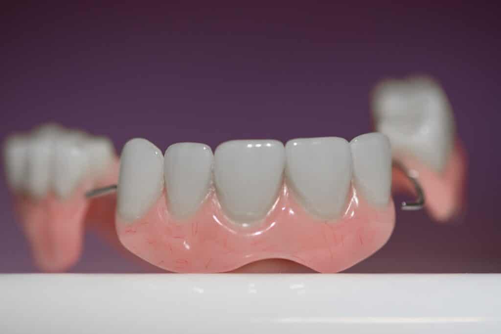 Dental Bridges