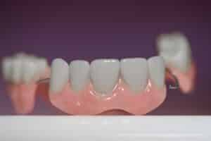 Dental Bridges