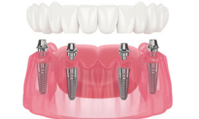 All on 4 dental implants benefits and functionality