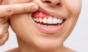 learn about gum disease and treatment