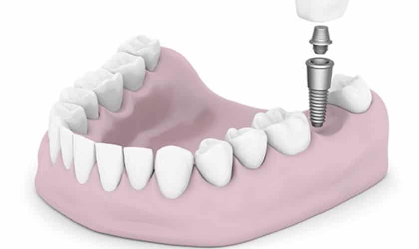 Implant Dentures Houston