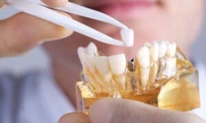 Houston Dentist explaining Dental Implants with a Prototype