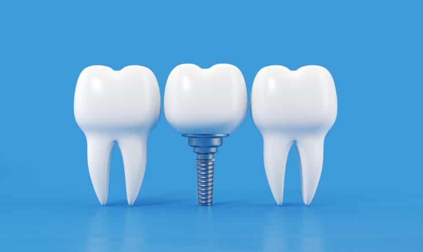 A dental implant prototype to prevent gum disease