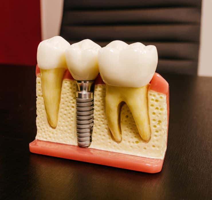 Dental Implant prototype in University Periodontal Associates dental office in Houston, TX