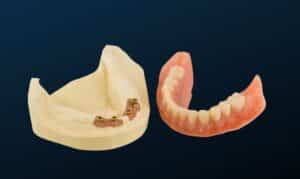 Implant-supported denture showing dental implant anchors in bone model and prosthetic teeth placement.