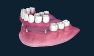 All-On-4 dental implant restoration showing artificial teeth attached to implant posts in the jawbone.