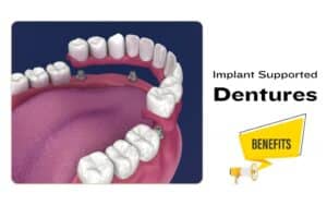 Implant supported dentures secured to dental implants in the jawbone for superior stability.