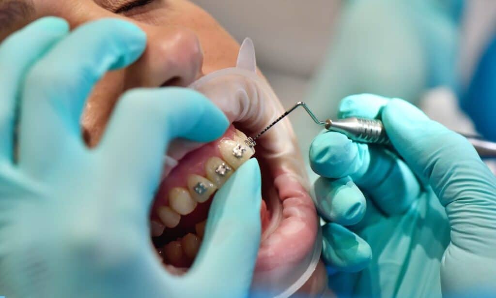 A patient undergoing braces treatment done by a Periodontist In Houston