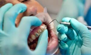 Dentist examining dental braces on patient's teeth during orthodontic treatment in Houston.