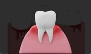 Healthy tooth surrounded by inflamed gum tissue showing signs of gum disease and bleeding.