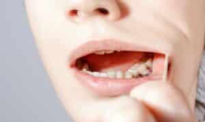 A person showing after gum grafting procedure