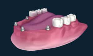 All-On-4 dental implant illustration showing prosthetic teeth supported by four implant posts in gum tissue.