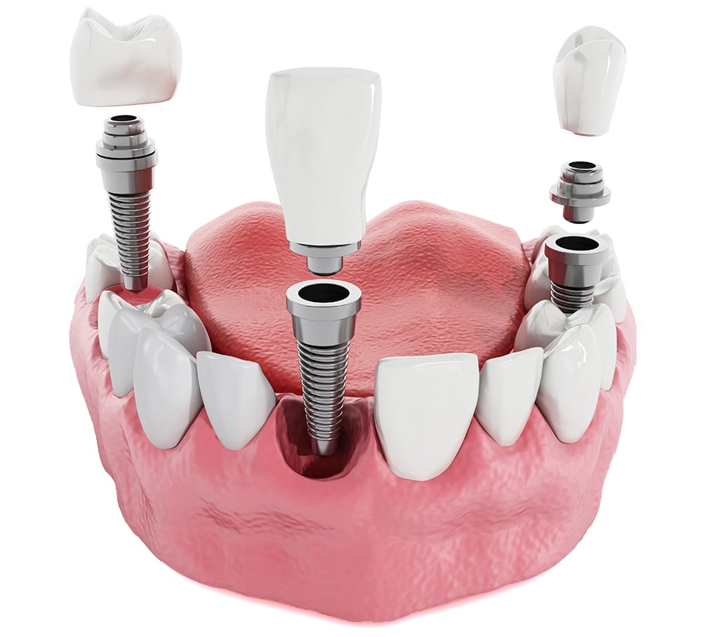 A graphic image showing the dental implants for multiple teeth