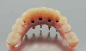 Denture implant prosthetic showing attachment points and artificial teeth placement for restoration.