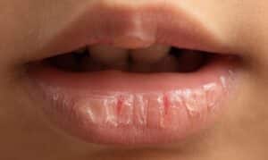 dry mouth problem