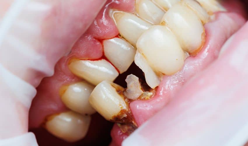 Gum disease and tooth loss