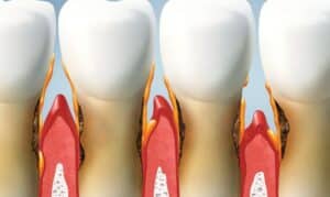 Dental illustration of gingival recession showing exposed tooth root and inflamed gum tissue.