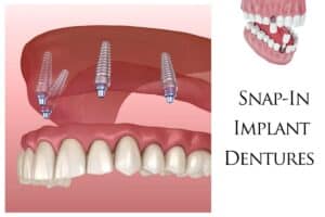 Snap-in implant dentures with dental implants anchoring prosthetic teeth in Houston.