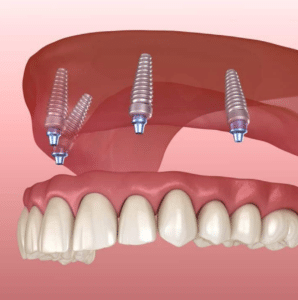 snap-in implant dentures