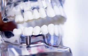 All on 4 dental implant candidacy