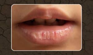 Close-up of healthy lips showing natural moisture and texture, relevant to dry mouth treatment discussion.