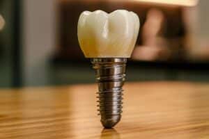 Dental implant model showing ceramic crown on metal screw fixture for tooth replacement.