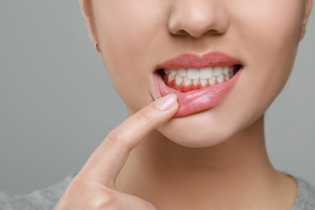Gum Disease Early Signs