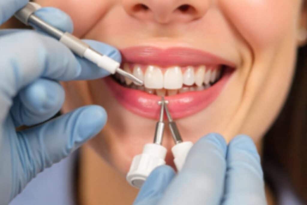Cosmetic gum contouring procedure for a balanced smile