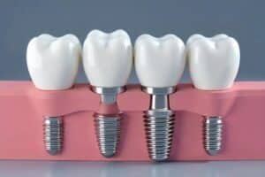 Dental implant components showing four tooth crowns with two titanium implant posts in pink gum model.