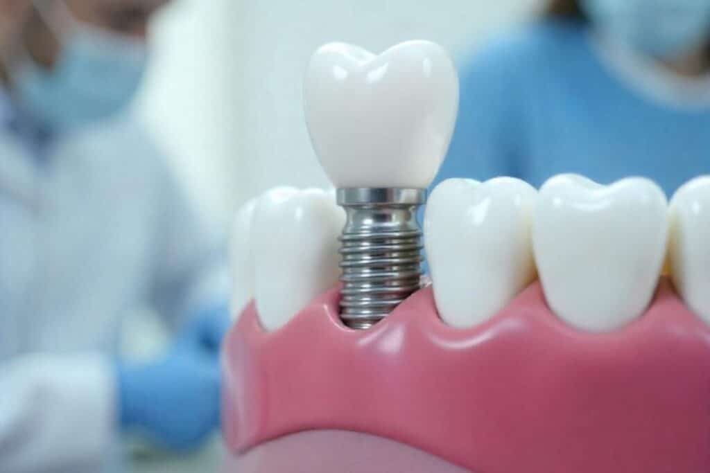 Dental implant model showing tooth replacement with crown and implant fixture on gum model.