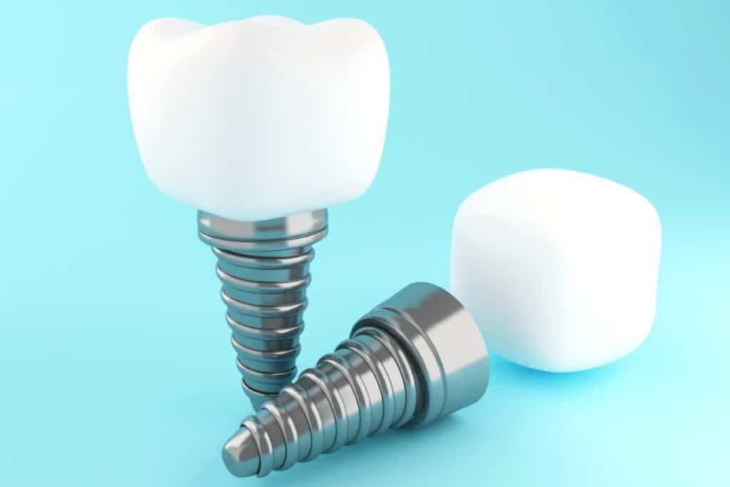 Dental Implants in Houston Texas