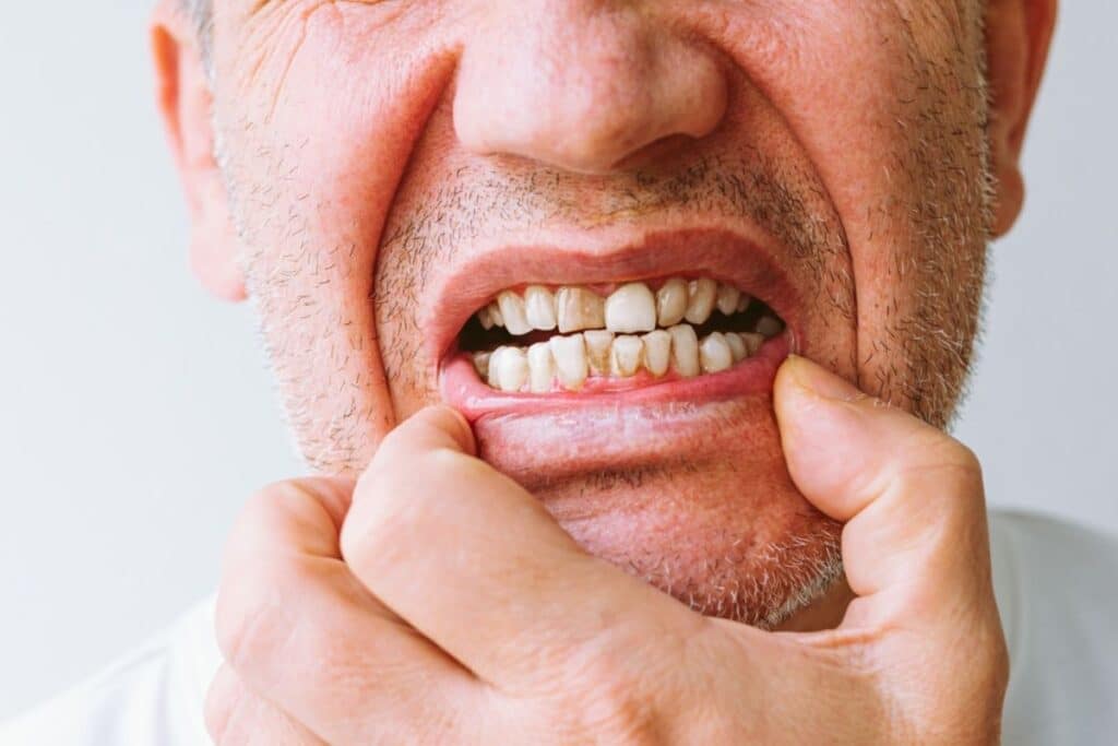 Gum Contouring Houston