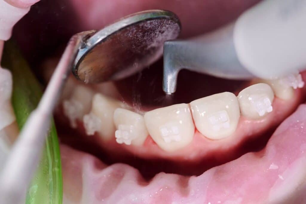 Gum Disease Treatment