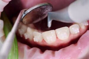 Close-up of gum recession showing exposed tooth root and dental instrument during periodontal examination.