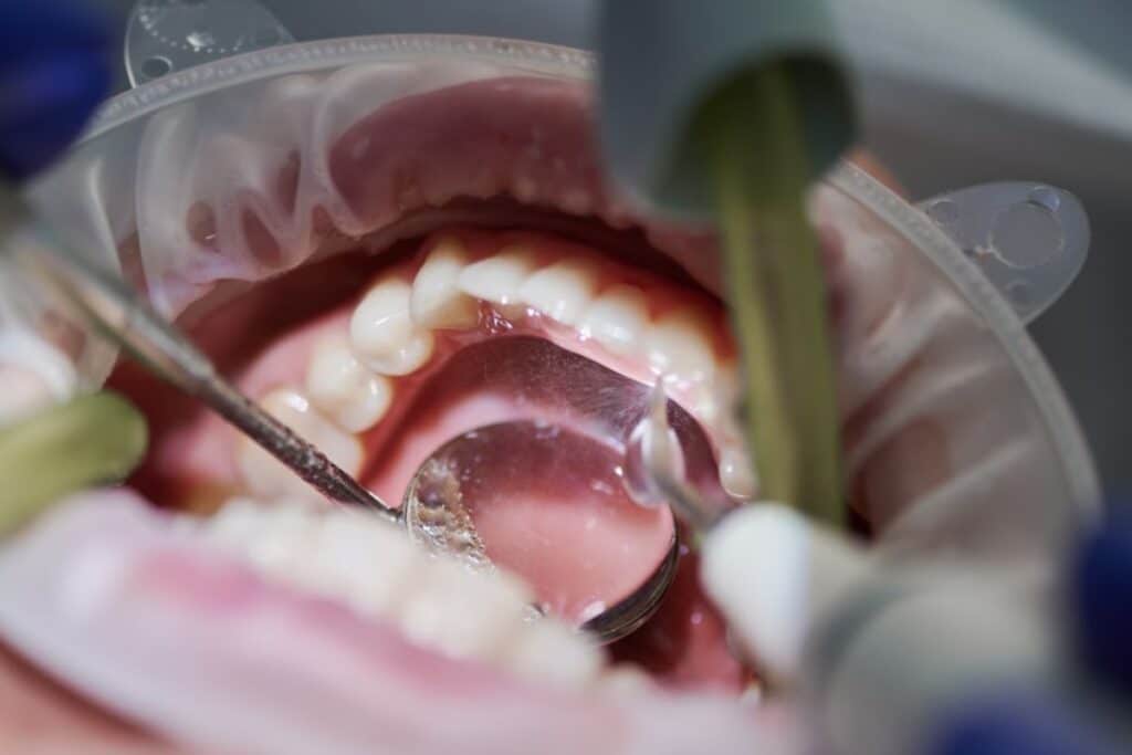 Dental examination showing open mouth with gums and teeth during periodontal checkup procedure.