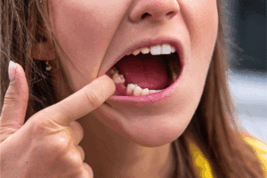 Dental Implants for Missing Teeth