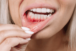 Gums Shrining Periodontist in Houston TX