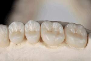 Implant supported dentures by University Periodontal Associates Houston Tx