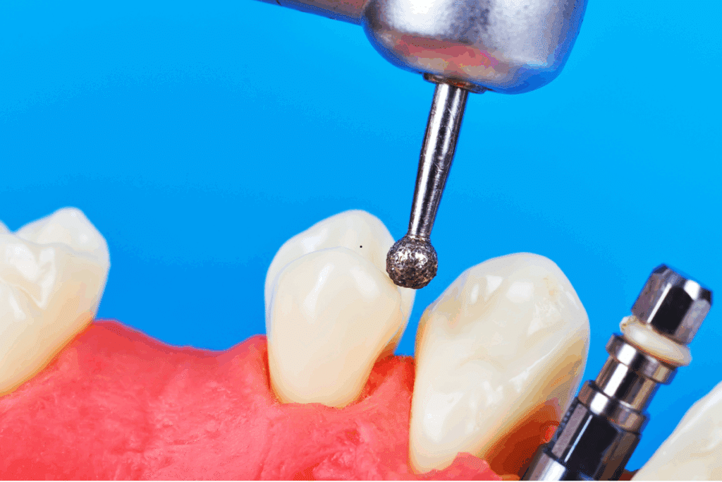Dental burr tool polishing tooth during All-on-4 or All-on-6 implant procedure.
