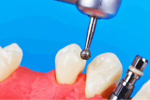 all on 4 vs all on 6 comparison by University Periodontal Associates Houston TX