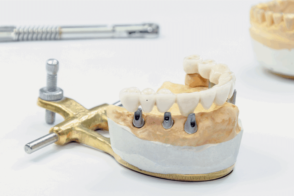 All-on-X Implant Concept described by University Periodontal Associates Houston TX