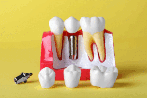Dental Implant Failure Sign
