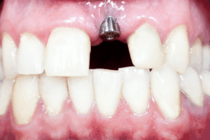 Dental Metals And MRI