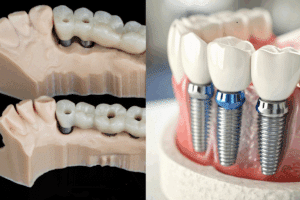 Choice Between Implants and Bridges