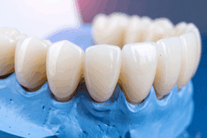 Dental Bridges